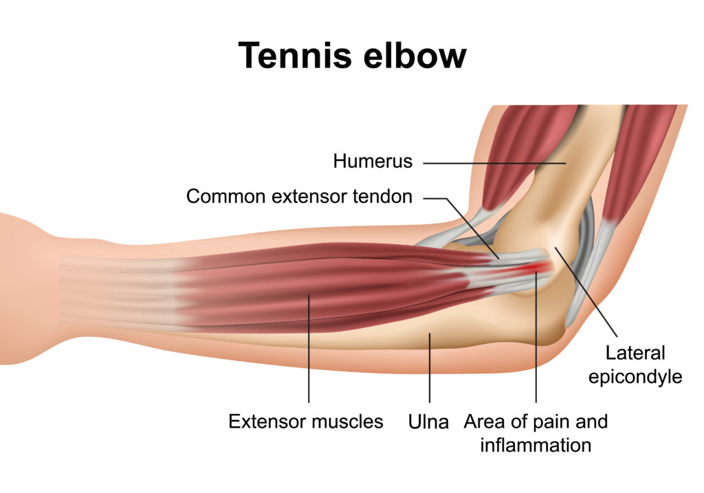 Acupuncture for Tennis Elbow